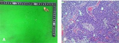 Case report: Strategies for improving outcomes in patients with primary ovarian small-cell neuroendocrine carcinoma